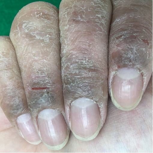 亀裂をともなうひどい手湿疹