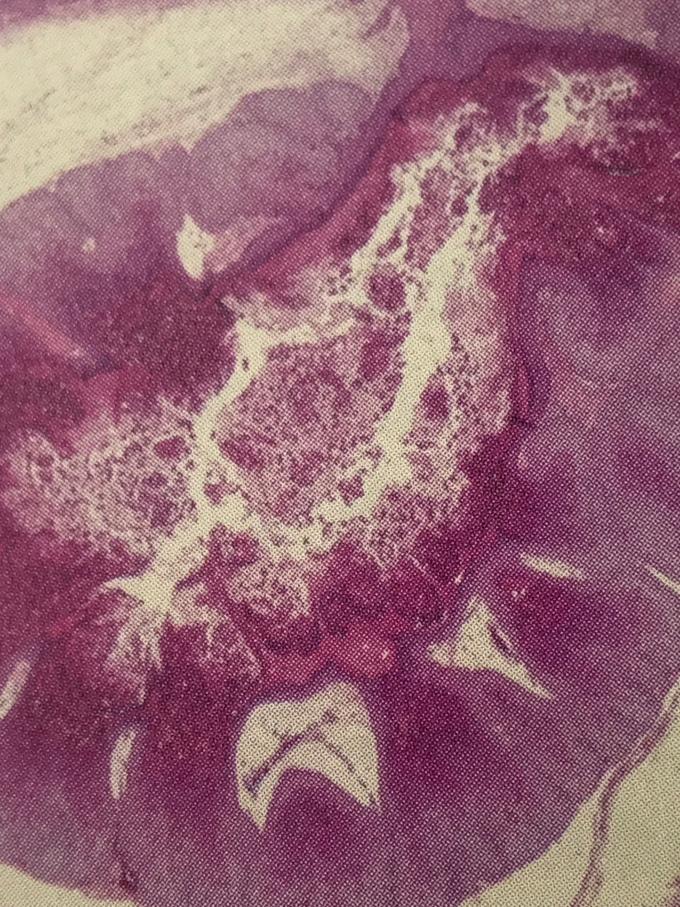 水イボ（Molluscum　body）の顕微鏡写真 ヘマトキシリン・エオジン染色 弱拡大